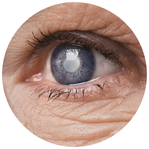Eye Damage and Form Cataract